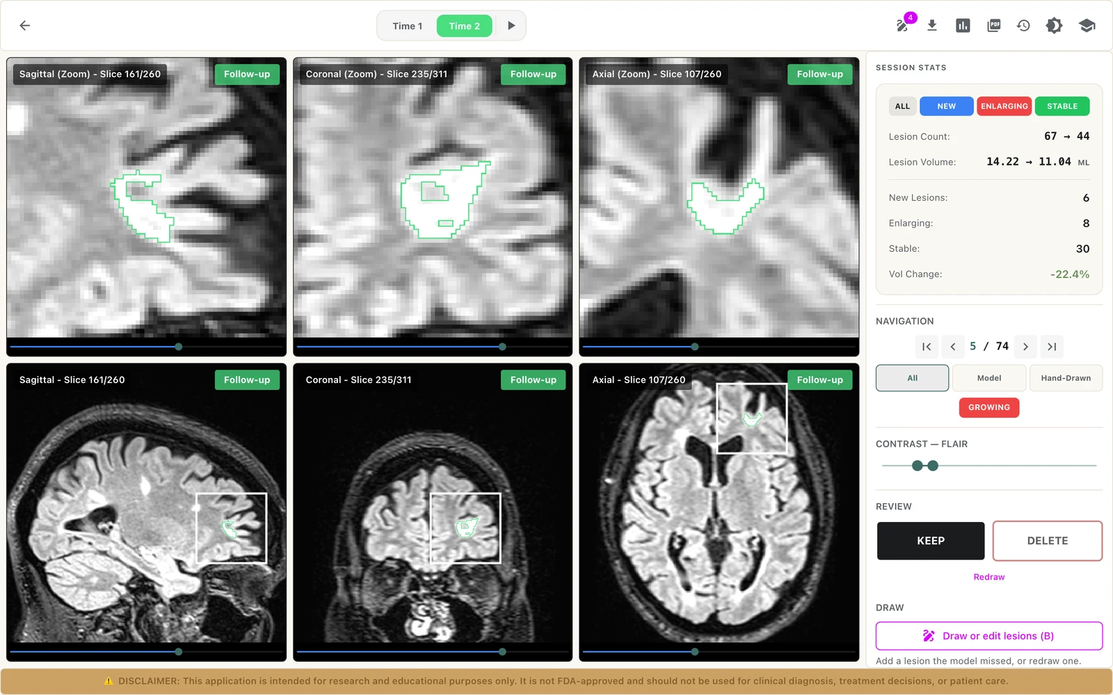 The LAMINATE Longitudinal Viewer: the follow-up session with a growing lesion outlined in three planes, session statistics and keep or delete buttons