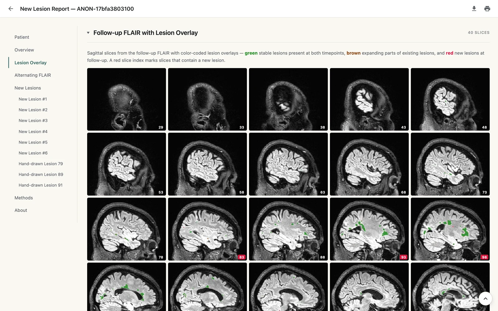A LAMINATE report page: a montage of follow-up FLAIR slices with new, expanding and stable lesions outlined in different colours
